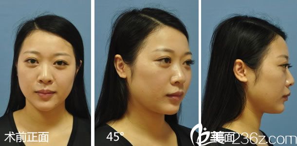 做鼻綜合整形手術前的鼻子