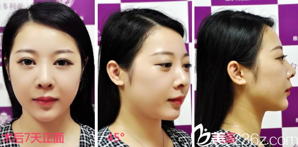 做鼻綜合手術7天正側面效果