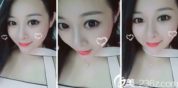 隆鼻手術第12天的效果圖片