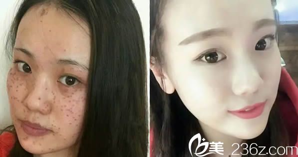 馮麗平祛斑前后對比效果
