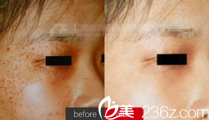 微針祛斑案例對(duì)比圖 微針祛斑案例對(duì)比圖