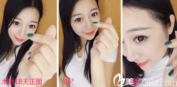 塌鼻子做手術第18天的效果