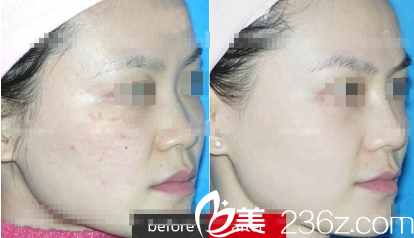 朗睿醫(yī)學(xué)祛斑案例 朗睿醫(yī)學(xué)祛斑案例