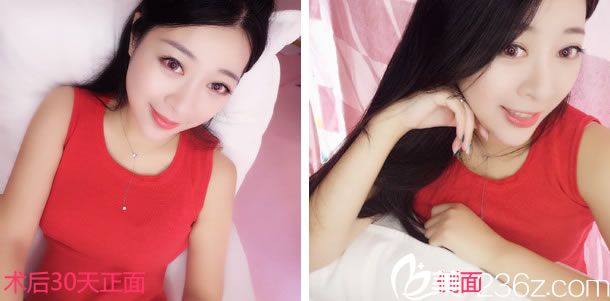 做鼻綜合整形手術1個月照片