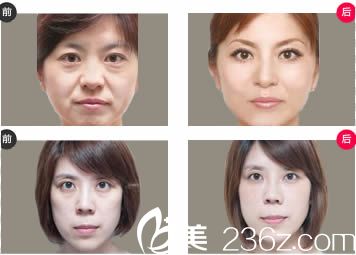 馮麗平主任抗衰除皺案例圖