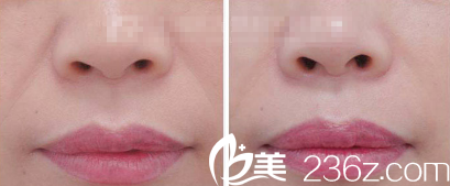 法令紋注射填充案例 法令紋注射填充案例