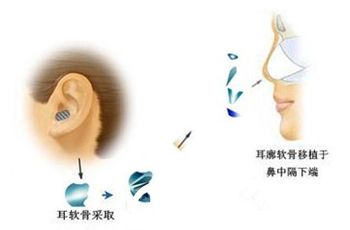 隆鼻尖時(shí)采取耳軟骨過程