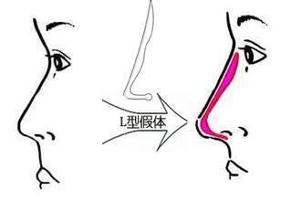 傳統(tǒng)假體隆鼻尖的方式