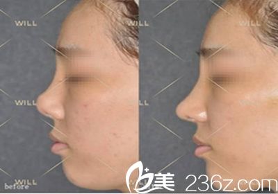 will醫(yī)院魏亨坤院長鼻整形案例