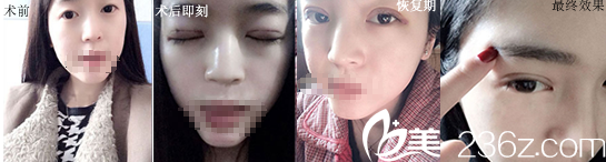 雙眼皮案例 雙眼皮案例