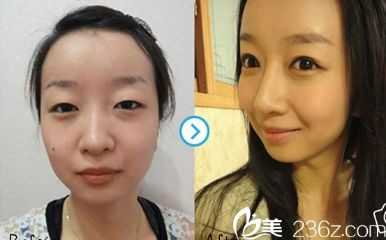 張小紅院長的雙眼皮案例圖 張小紅院長的雙眼皮案例圖