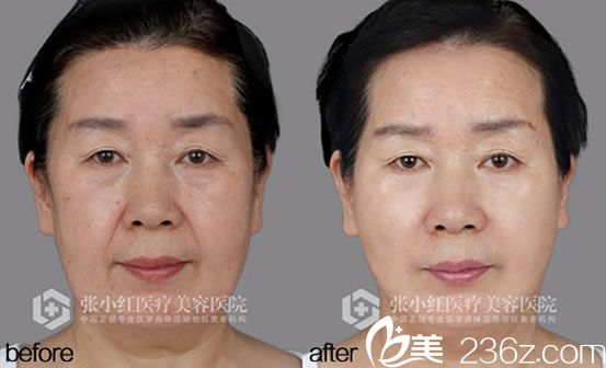 張小紅院長的自體脂肪填充案例 張小紅院長的自體脂肪填充案例