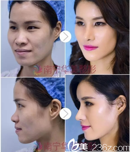 南寧華美盧志剛隆鼻案例