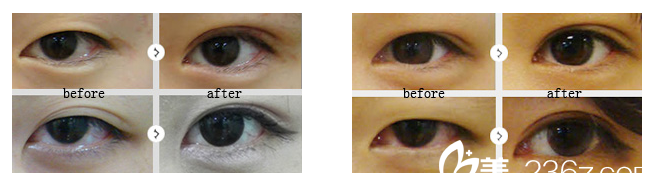 南寧華美盧志剛雙眼皮案例