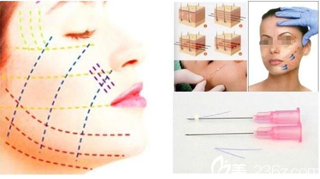 面部埋線提升原理 面部埋線提升原理