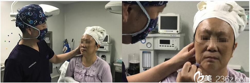 線雕手術(shù)前畫線 線雕手術(shù)前畫線