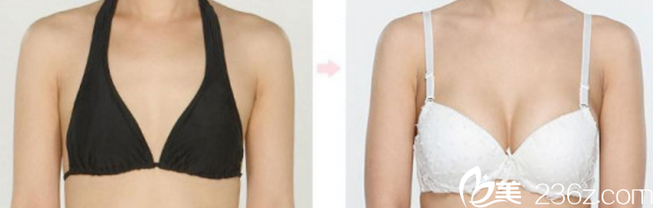 彭見(jiàn)生隆胸手術(shù)照 彭見(jiàn)生隆胸手術(shù)照