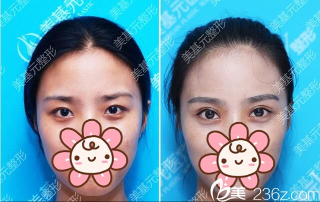 埋線雙眼皮前后對比案例 埋線雙眼皮前后對比案例