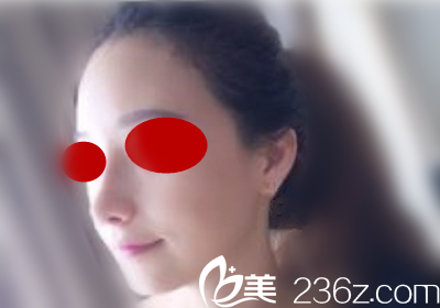 去韓國(guó)做鼻綜合術(shù)后半個(gè)月回國(guó)
