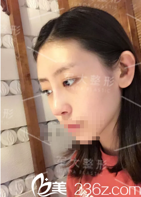 鐘正強(qiáng)硅膠鼻綜合術(shù)后5天恢復(fù)情況