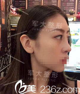 硅膠鼻綜合手術(shù)拆線后效果