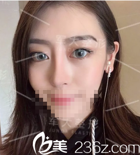 硅膠假體+耳軟骨墊鼻尖1個(gè)月正面照