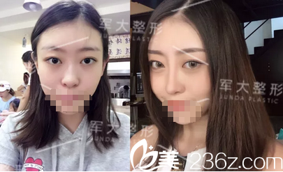 鐘正強(qiáng)硅膠鼻綜合術(shù)前術(shù)后對比照