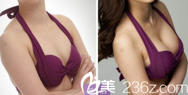 太原華美楊松林醫(yī)生隆胸案例 太原華美楊松林醫(yī)生隆胸案例