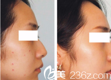 太原華美激光點痣優(yōu)惠價50元/個