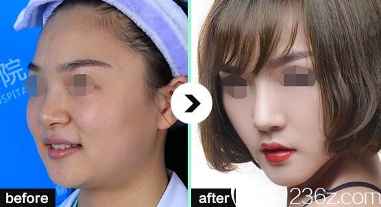 面部綜合整形案例 面部綜合整形案例