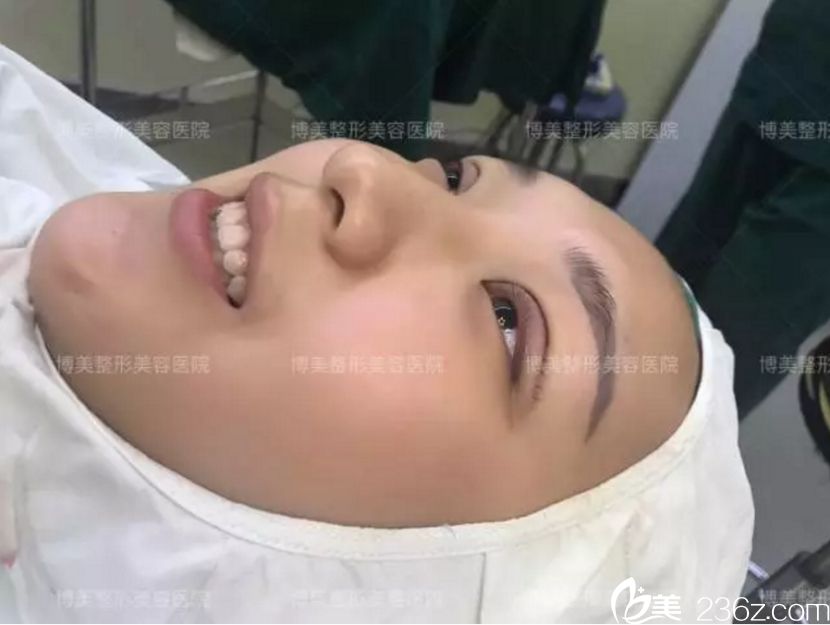 永州博美 雙眼皮術(shù)后