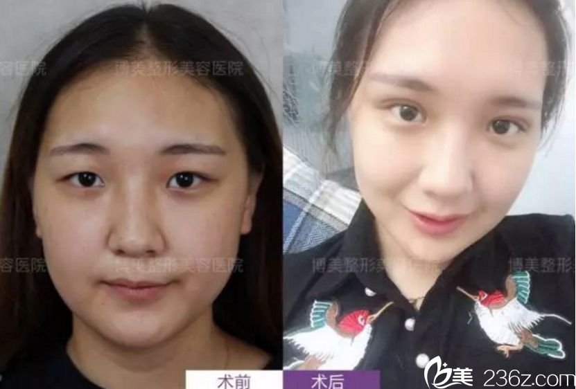 永州博美做雙眼皮前后對比