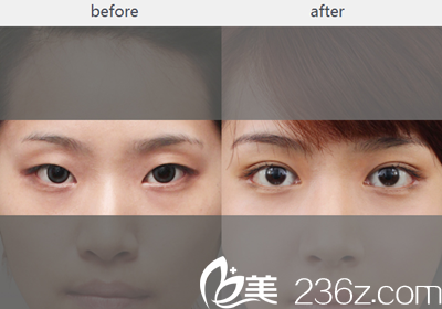 原辰整形醫(yī)院埋線雙眼皮手術(shù)案例