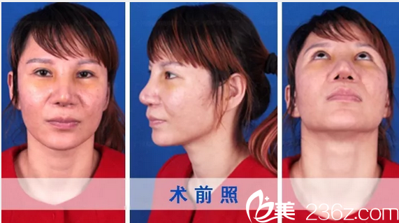 隆鼻失敗修復(fù)術(shù)前照片 隆鼻失敗修復(fù)術(shù)前照片