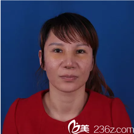 鼻修復(fù)術(shù)前正面照 鼻修復(fù)術(shù)前正面照