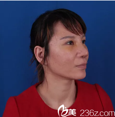 鼻修復(fù)術(shù)前側(cè)面照片 鼻修復(fù)術(shù)前側(cè)面照片