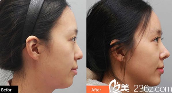 假體隆鼻案例圖