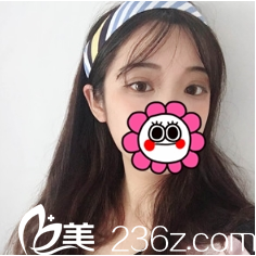 全切雙眼皮案例術(shù)后半年效果太原華美于智宏