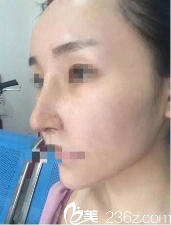 術(shù)后7前拆線效果 術(shù)后7前拆線效果