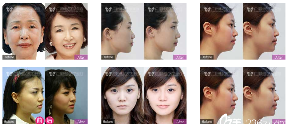 廣州韓妃陳坦醫(yī)生案例 廣州韓妃陳坦醫(yī)生案例