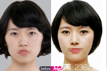 楊建鼻綜合+面部脂肪填充案例