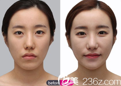 楊建面部脂肪填充精雕案例對比照