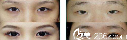 太原美媛薈李莉婷醫(yī)師眼綜合案例