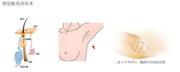 余繼平醫(yī)生祛腋臭微創(chuàng)手術(shù)原理