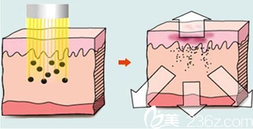 激光祛黃褐斑原理