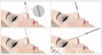 哈爾濱仁美線雕隆鼻原理