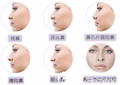 哈爾濱仁美線雕隆鼻適應(yīng)人群