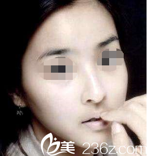 隆鼻后我的鼻子會(huì)變成什么樣