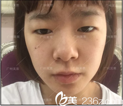 雙眼皮術(shù)前照片 雙眼皮術(shù)前照片