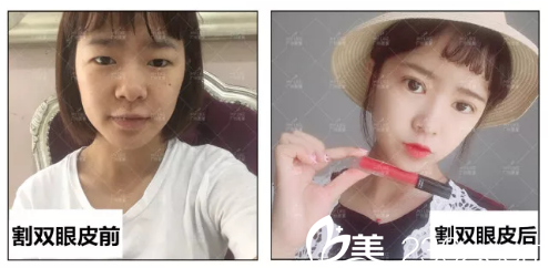 廣州美萊田躍平雙眼皮對(duì)比案例 廣州美萊田躍平雙眼皮對(duì)比案例